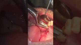 Extraction of upper right second molar roots [upl. by Haleak]