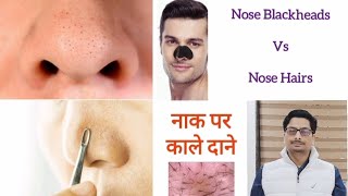 Trichostasis Spinulosa  Nose Blackheads  Nose Hairs  Nose Acne नाक पर काले दाने और बाल nosehair [upl. by Chaiken]