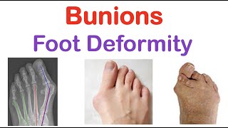 How to Treat a Bunion of the Big Toe [upl. by Trebleda]