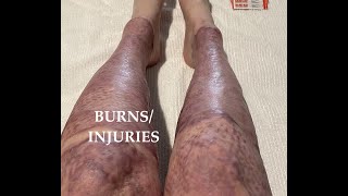 My burns  injuries [upl. by Eniarrol]