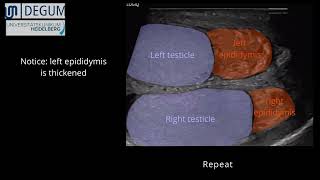 Episode 42 Epididymitis [upl. by Netsud]