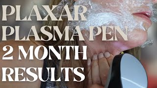 Plaxar Plasma Pen 2 Month Documentation Before amp After Face Tightening cosmetology [upl. by Olathe]