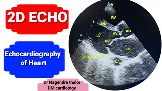 2D Echocardiography of heart Echo test in hindiHeart pumping valvesHole by ECHO [upl. by Mallissa]