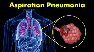 Breathing Trouble Understanding Aspiration Pneumonia [upl. by Ominorej]