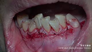 Apicically repositioned flap  APF with labial strip free gingival graftFGG [upl. by Rehtae]