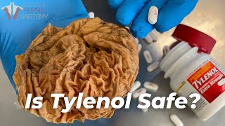 Should You Stop Taking Tylenol AcetaminophenParacetamol [upl. by Aelrac]