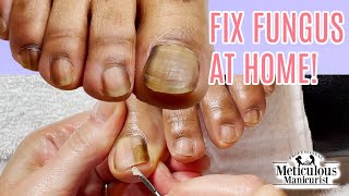 Toenail Fungus Cleaning at Home Success [upl. by Dranoc]