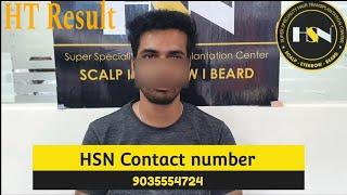 HSN Hair Transplant result 6 months completed result review in kannada  hsn fue hair [upl. by Sirroned]