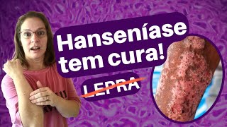 Sintomas tratamento e cura da Hanseníase [upl. by Siari]