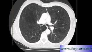 Emphysema on CT scan of Chest [upl. by Kelcie]