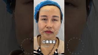 筋膜提升 beauty 面膜 醫美推薦 makeupartist 推薦 [upl. by Reinnej]