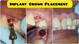 How a Dentist do Front Tooth Dental Implants Crown Placement Procedure  Dental Aesthetics  Smile [upl. by Noloc966]