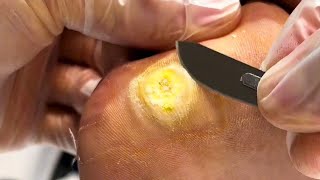 Pedicure Tutorial A Quick Fix for Plantar Warts [upl. by Atikim]