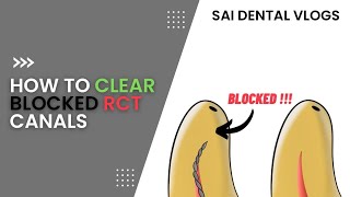 HOW TO CLEAR BLOCKED RCT CANALS  FILE NOT REACHING APEX [upl. by Garrity]