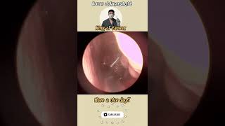 귀지형 콧물 부비동염 축농증 비염 코청소 이비인후과 rhinorrhea rhinitis sinusitis asmr ENT entdoctor [upl. by Anaiek]