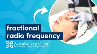 Fractional Radio Frequency Skin Tightening Treatment  Australian Skin Clinics [upl. by Ayomat]