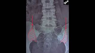 Osteitis Condensans Ilii vs Sacroiliitis [upl. by Droffig140]