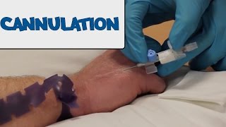 How to Perform Cannulation  OSCE Guide old version  UKMLA  CPSA [upl. by Niwhsa]