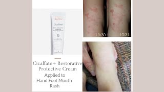 Avène Cicalfate Restorative Protective Cream used on Hand Foot Mouth Rash cleared FAST [upl. by Elocyn]