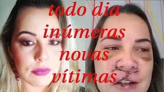 Entrevista com modelo vítima de harmonização facial feita com PMMA [upl. by Yrelav256]