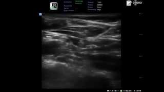 ultrasound guided supraclavicular brachial plexus block in one minute only [upl. by Redle]