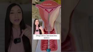 ¿Cómo se coloca el DIU👩🏻‍⚕️ salud medicina mujer diu doctora shorts [upl. by Arrehs]