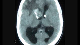 Frontal Intraventricular tumor with hydrocephalus [upl. by Ilanos]