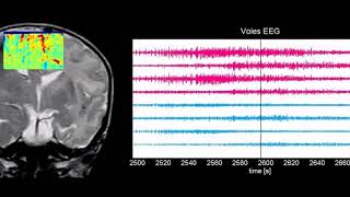 Neuroimagerie fonctionnelle par ultrasons chez le nouveauné [upl. by Nidla]