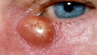 Lacrimal Abscess [upl. by Maroney]