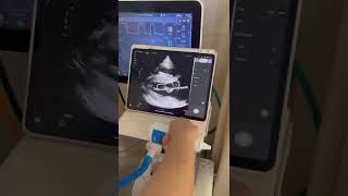 Portable Handheld Wireless Cardiac Ultrasound portableultrasound [upl. by Anivla]