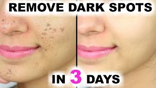 In 3 DAYS  Remove DARK SPOTS BLACK SPOTS amp ACNE SCARS  Anaysa [upl. by Eileme]