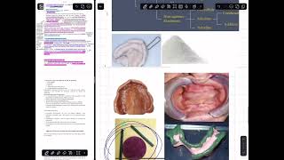 شرح prosthodontics lec 5 impression material and techniques for RPD طب اسنان مرحله رابعه [upl. by Justina]