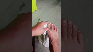 draining out excessive blood from an injured toe nail [upl. by Dorisa]