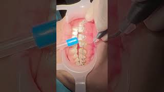 Laser gingivectomy to treat the swelled gum during bracestreatment and to correct the gummysmile [upl. by Leroy]