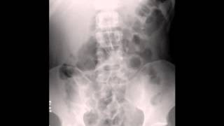 Left Lower Lobe Pneumonia in Abdominal X ray [upl. by Llert]