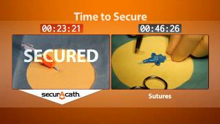 SecurAcath vs Sutures [upl. by Serles]