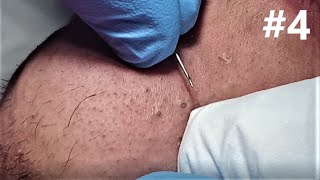 BIG BLACKHEADS EXTRACTIONS on Happy  4 [upl. by Clothilde529]