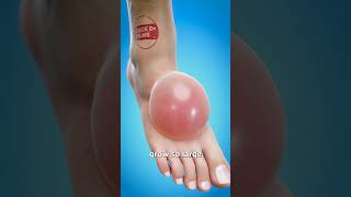 Should You Pop Giant Blisters 💦 [upl. by Adnovahs]