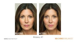 Radiesse® and Belotero Balance® at Boynton Plastic Surgery [upl. by Lenox]