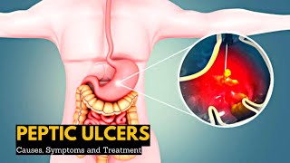 Peptic Ulcers Causes Signs and Symptoms Diagnosis and Treatment [upl. by Steep233]