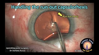 CataractCoach 1400 handling the runout capsulorhexis [upl. by Aniham47]