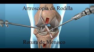 Artroscopia de Rodilla Cirugía de Menisco [upl. by Ym]