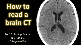 How to read a brain CT part 1 Basic principles of CT and CT interpretation [upl. by Judith736]