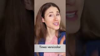 Tinea Versicolor pityriasis versicolor  USMLE Quick Review [upl. by Virgel539]