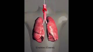 Lung SoundsNormal and AbnormalCracklesWheeze StridorRonchiOn Respiratory Auscultation Sound [upl. by Emie]