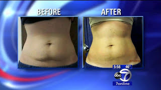 How CoolSculpting works [upl. by Isaiah581]