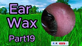 ear wax removal asmr animation [upl. by Hermina]