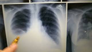 Pulmonology Radiology Pleural Effusion Chest Xray Loss Of Costophrenic Angle [upl. by Yslek679]