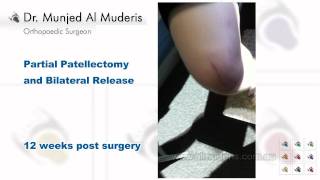 Partial Patellectomy and Bilateral Release  12 weeks post surgery [upl. by Kloman]