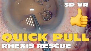 3D Phaco Clip 160  The Quick Pull Maneuver on a Morgagnian Cataract VR Headset Version [upl. by Arbe]